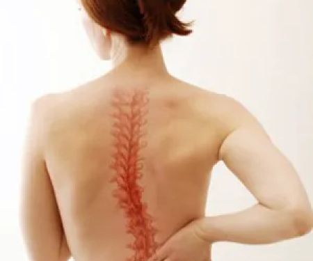 ScoliSmart - Scoliosis Treatments