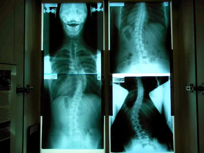 Strauss Scoliosis Correction Picture 9