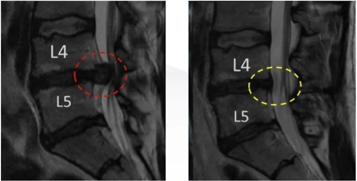 Spinal Decompression Picture 2