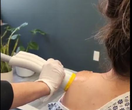 SoftWave Therapy Cincinnati