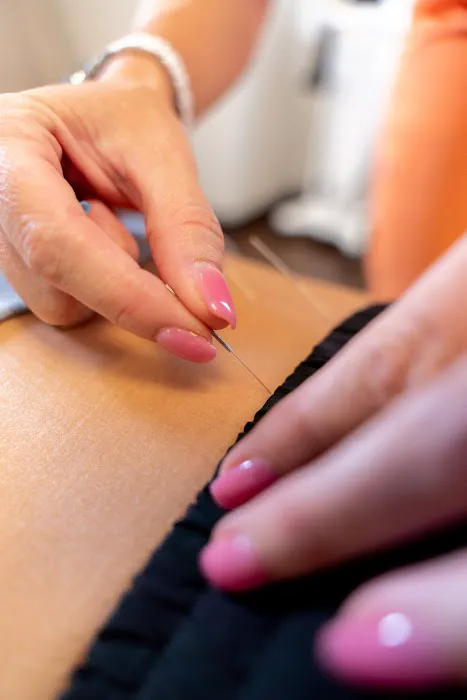 Dry Needling Method Picture 1