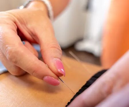 Dry Needling Method