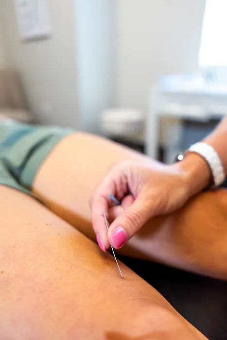 Dry Needling Method Picture 4