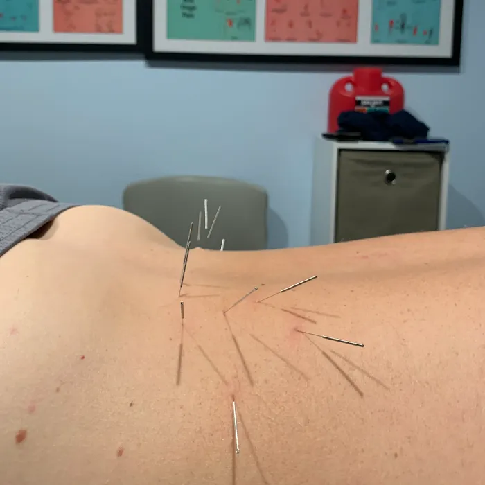 Dry Needle Pain Relief at Chanatry Chiropractic Picture 9