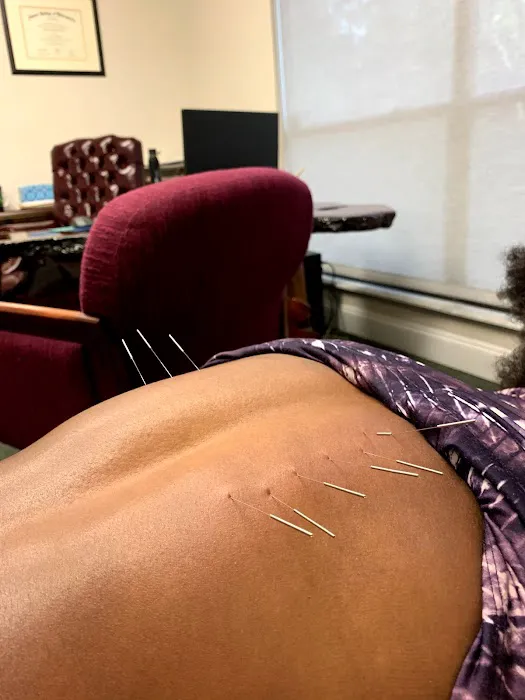 Dry Needle Pain Relief at Chanatry Chiropractic Picture 2