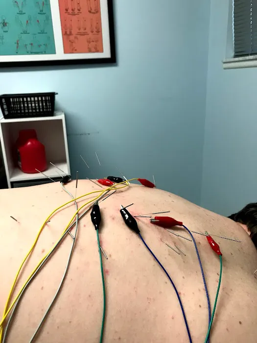 Dry Needle Pain Relief at Chanatry Chiropractic Picture 5