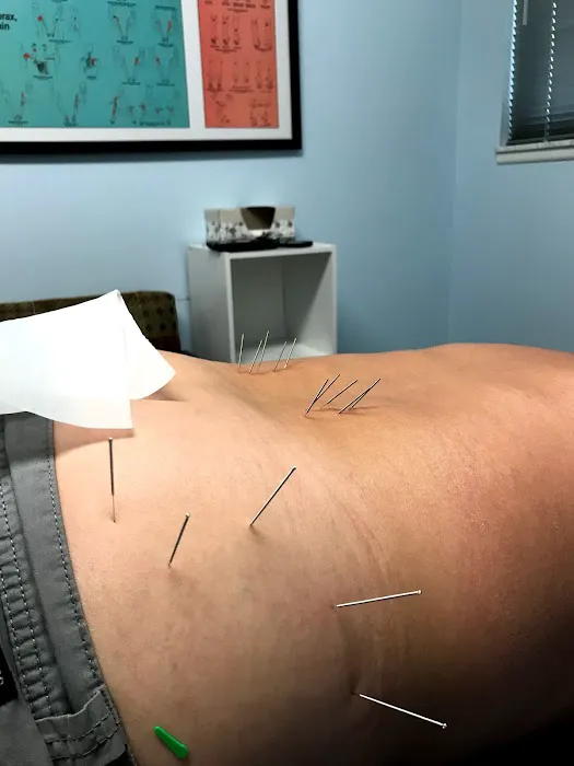 Dry Needle Pain Relief at Chanatry Chiropractic Picture 6