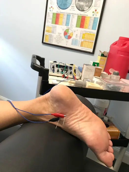 Dry Needle Pain Relief at Chanatry Chiropractic Picture 3