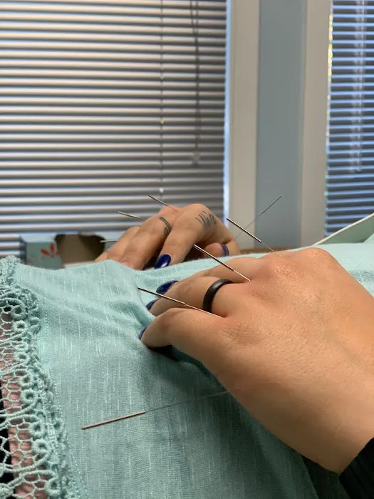 Dry Needle Pain Relief at Chanatry Chiropractic Picture 10