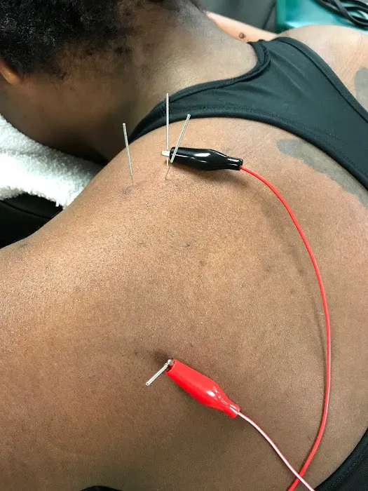 Dry Needle Pain Relief at Chanatry Chiropractic Picture 4
