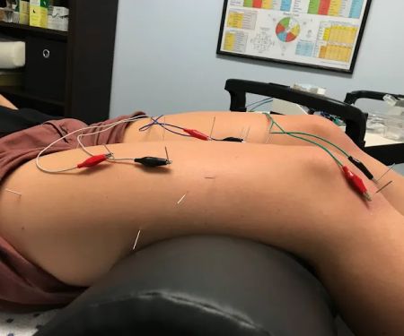 Dry Needle Pain Relief at Chanatry Chiropractic