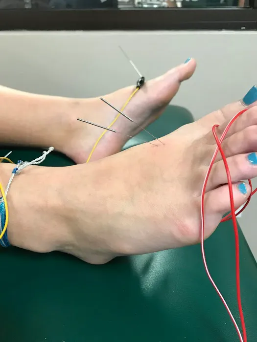 Dry Needle Pain Relief Picture 2