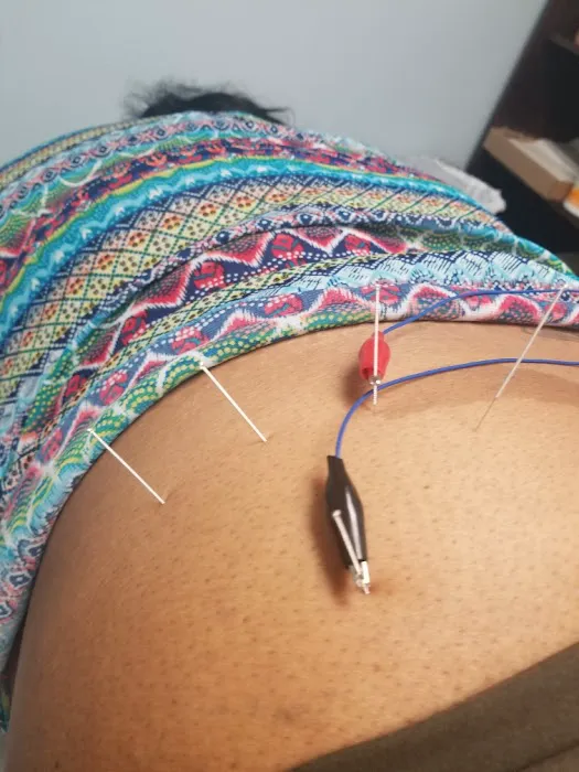 Dry Needle Pain Relief Picture 8