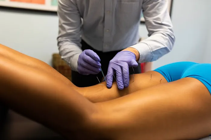 Dry Needle Pain Relief Picture 1