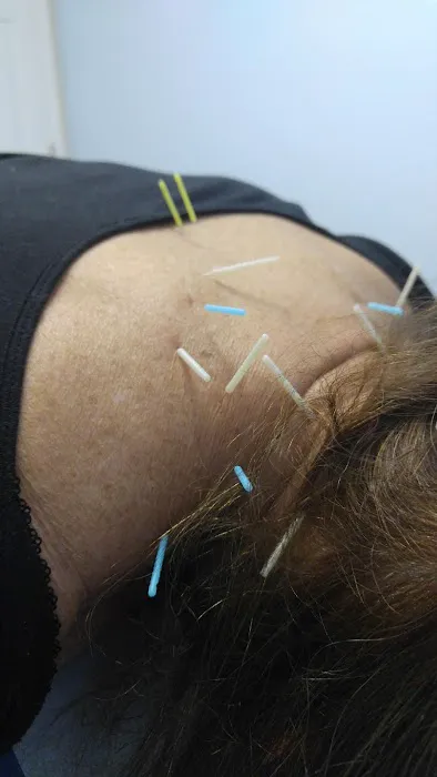 Dry Needle Pain Relief Picture 3