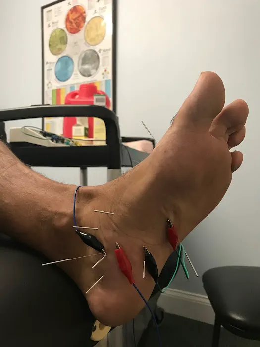 Dry Needle Pain Relief Picture 4