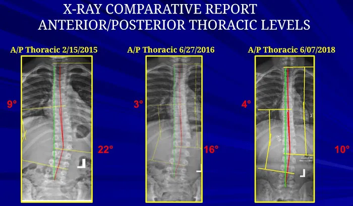Hartley Chiropractic and Scoliosis Center in St. Augustine FL Picture 5