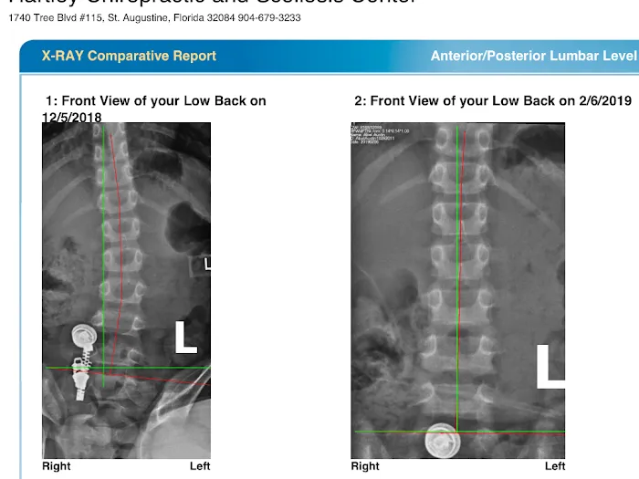 Hartley Chiropractic and Scoliosis Center in St. Augustine FL Picture 4
