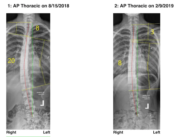 Hartley Chiropractic and Scoliosis Center in St. Augustine FL Picture 3