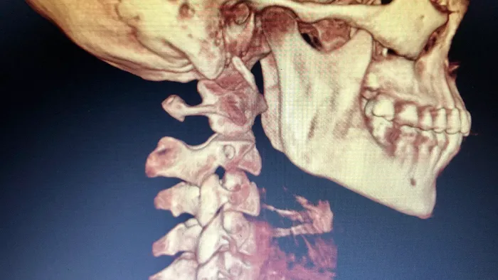 Los Angeles Upper Cervical Picture 3