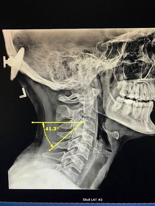 Los Angeles Upper Cervical Picture 8