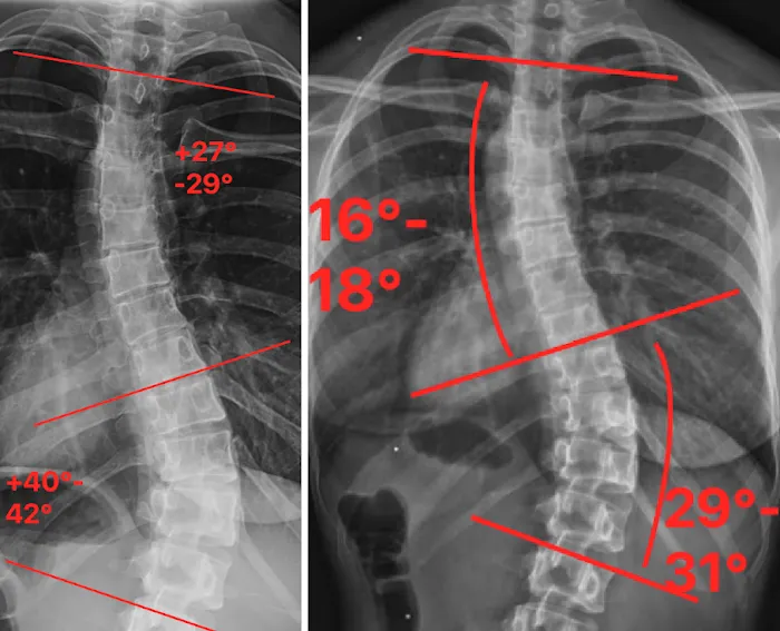 Scoliosis Correction Center Picture 4