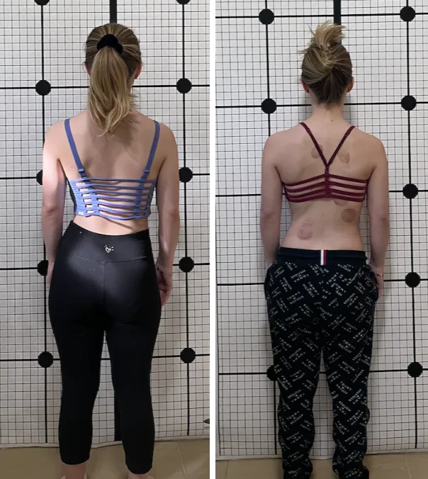 Scoliosis Correction Center Picture 3