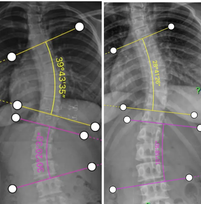 Scoliosis Correction Center Picture 2