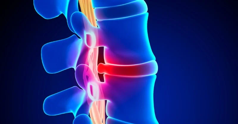 Expert Tips for Managing Herniated Disc Care Naturally with Chiropractic Care