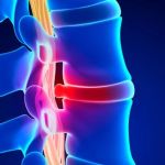 Expert Tips for Managing Herniated Disc Care Naturally with Chiropractic Care