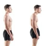 What Causes Posture Correction and How Chiropractors Treat It | Posture Health