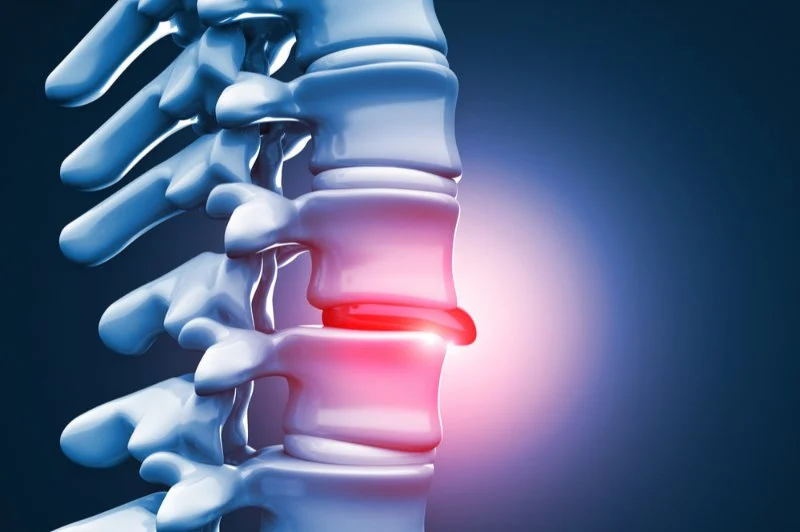 How to Relieve Herniated Disc Pain Without Medication – Chiropractor Approved Solutions