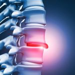 How to Relieve Herniated Disc Pain Without Medication – Chiropractor Approved Solutions