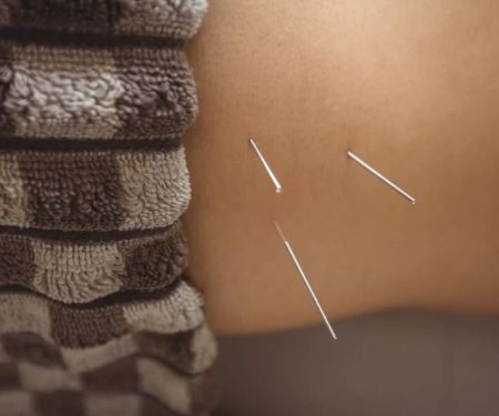 Chiropractic vs Acupuncture for Chronic Pain: Key Differences Explained