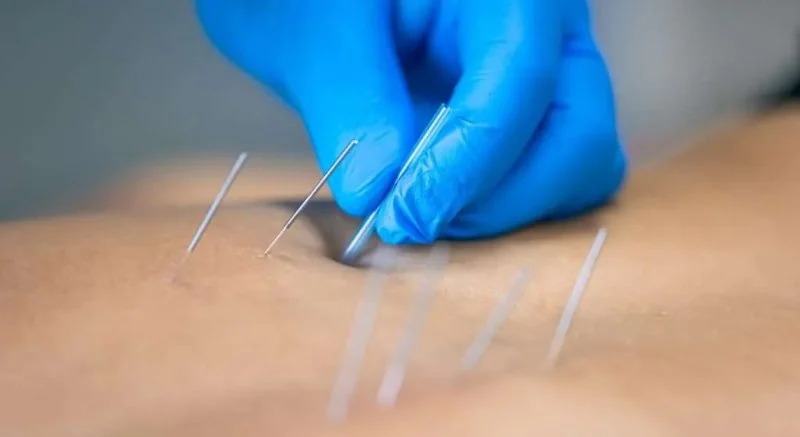 Chiropractic vs Dry Needling: Key Differences Explained