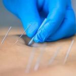 Chiropractic vs Dry Needling: Key Differences Explained