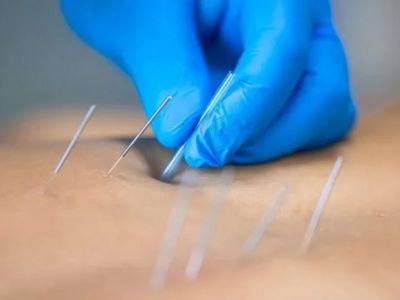 Chiropractic vs Dry Needling: Key Differences Explained