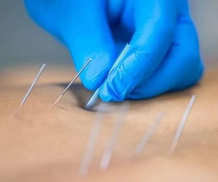 Chiropractic vs Dry Needling: Key Differences Explained